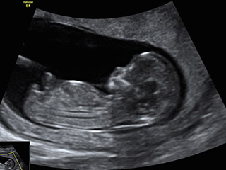 Echographie obstétricale : Définition et déroulement