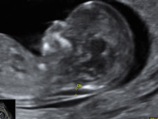 Echographie obstétricale de grossesse du TROISIEME TRIMESTRE chez la femme  enceinte sans ordonnance - Centre de santé du Marais