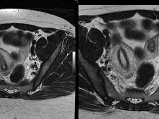 IRM pelvienne | Imagerie de la femme